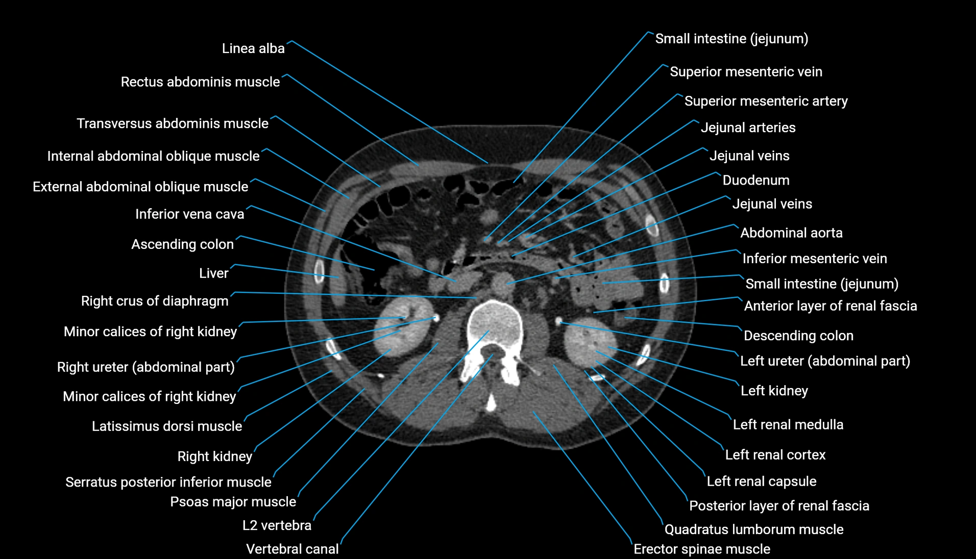 CT urogram axial cross sectional anatomy  labelled radiology image-00112.webp